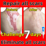 Scar Removal Cream Old Scar Cream Effective Repair New Scars Surgical Scars Stretch Marks Acne Pits Acne Marks Burn Scars