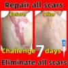 Scar Removal Cream Old Scar Cream Effective Repair New Scars Surgical Scars Stretch Marks Acne Pits Acne Marks Burn Scars
